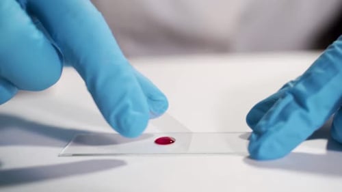 A Close-up Shot Is a Blood Test Procedure in a Laboratory. Concept - Laboratory Tests, Blood Test