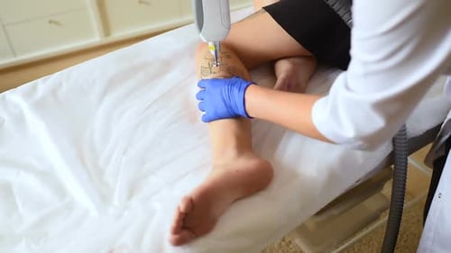 the Cosmetologist Removes the Tattoo on the Leg of a Young Pretty Girl with a Laser