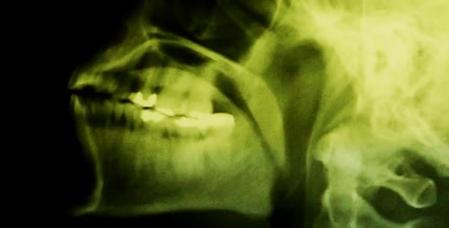 Skull X-Ray