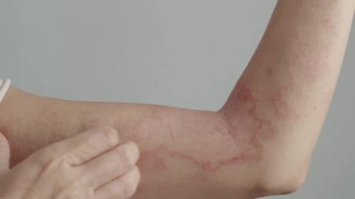 Frau kratzt sich mit Dermatitis am Arm