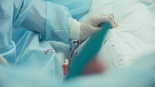 Coronary Bypass Surgery Procedure