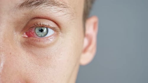 Closeup of the Red Eye of a Man Affected By an Infection