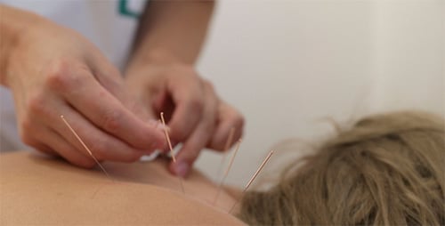 Traitement par acupuncture