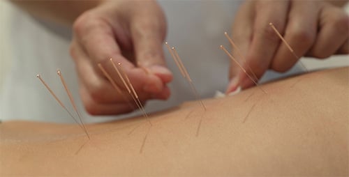 Behandlung durch Akupunktur
