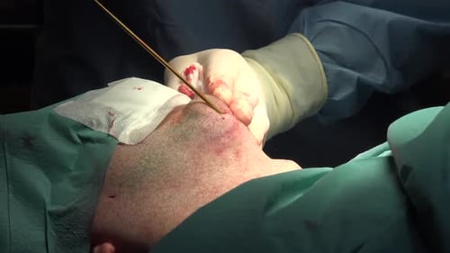 Rhinoplasty Surgery Close-Up in Operating Room