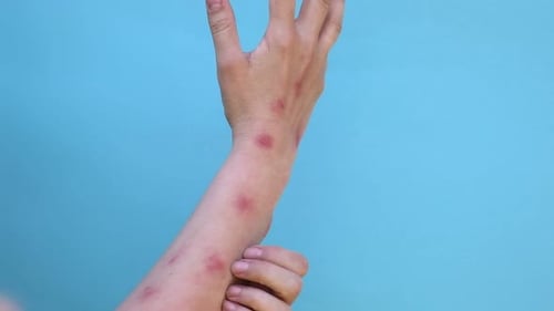 Person Scratching Arm with Rash