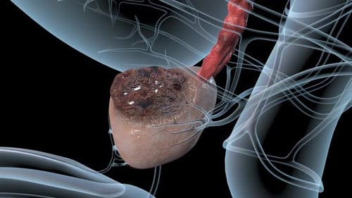 Human Prostate Disease Progression 3D Medical Animation