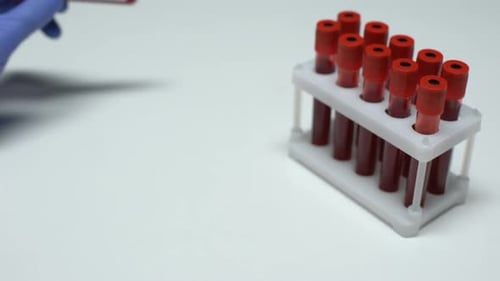 SARS Positive Blood Test in Laboratory Setting