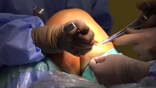 Knee Surgery Close Up in Operating Room