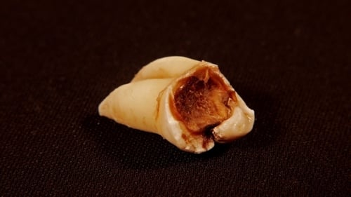 Close Up of an Extracted Damaged Tooth