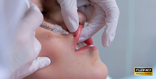 Lip Augmentation
