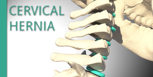 Cervical Hernia