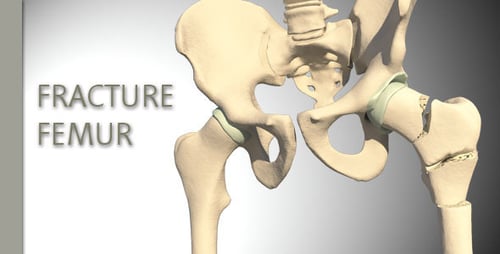 Medical 3D Animation of Human Hip Fracture and Healing