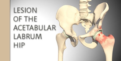 3D Animation of Human Hip Joint Anatomy and Osteoarthritis
