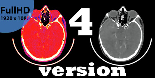 Magnetic Resonance Imaging of the Brain - CT Scan
