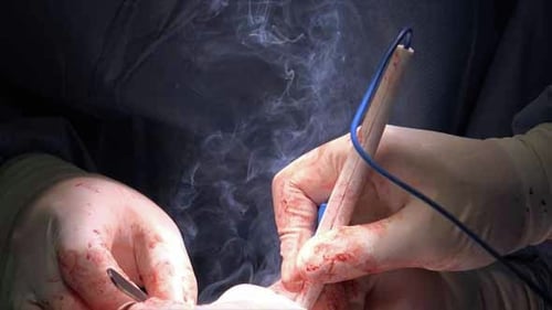Surgeon Using Medical Tool Emitting Smoke Close Up