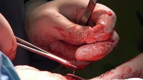 Surgical Suture Or Stitches 14