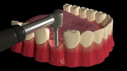 3D Dental Implant Procedure Animation for Medical Presentations
