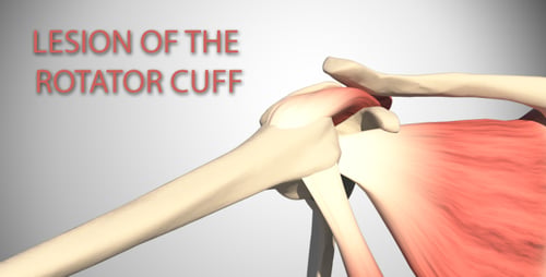 3D Animation of Human Shoulder Rotator Cuff Injury