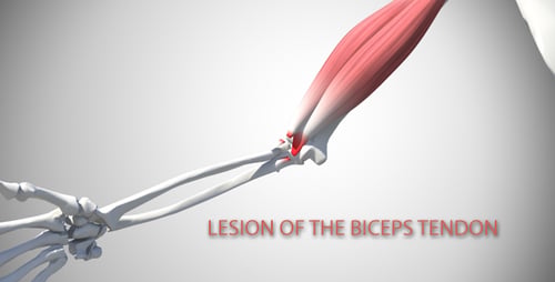Lesion Of The Biceps Tendon