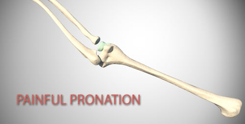 Painful Pronation