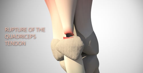3D Human Knee Joint Anatomy with Meniscus Injury Animation