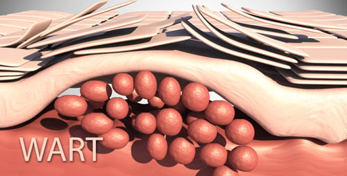 Wart