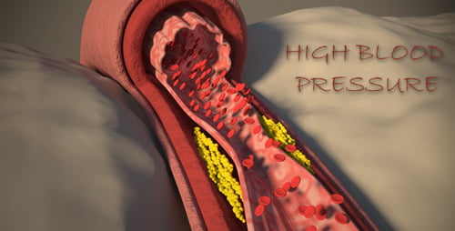 Atherosclerosis Plaque Formation in Artery Medical Animation