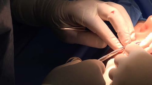 Blepharoplasty or Eyelid Surgery 2