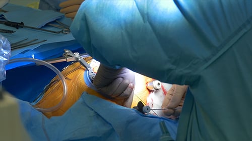 Chirurgie bei Herzinterventionen