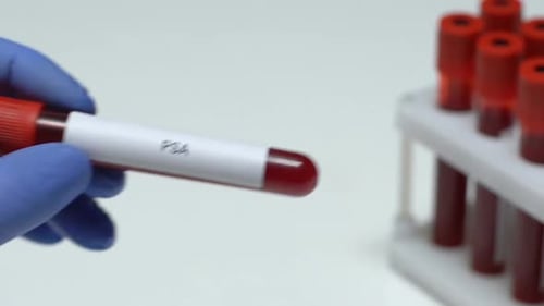 PSA, Laboratory Worker Holding Blood Sample in Tube Close-Up, Health Check-Up