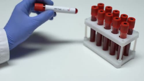 Positive HIV Test Blood Sample in Vial