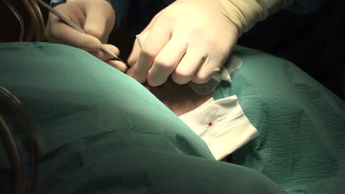 Facial Liposuction