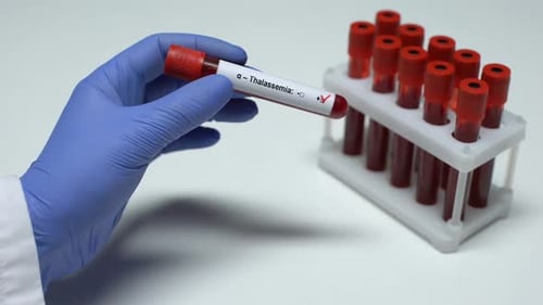 Positive a Thalassemia Test, Doctor Showing Blood Sample in Tube, Health Checkup