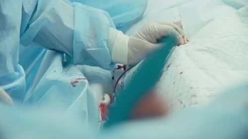 Coronary Bypass Surgery Procedure