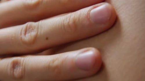 Moles On Body Dermatologie