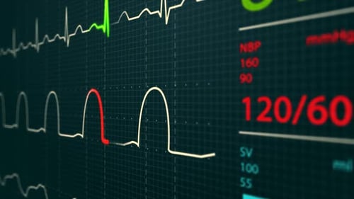 Animation of Intensive Care Unit monitor showing normal values for vital signs.