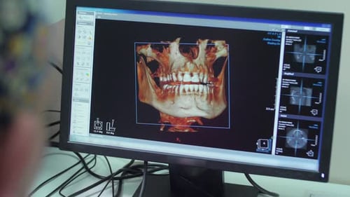 3D view of maxillary and mandible on a screen