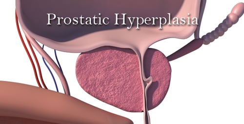 Prostatic Hyperplasia