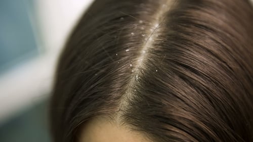 Close Up View of Scalp with Dandruff