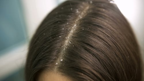 Close Up of Woman's Hair with Dandruff
