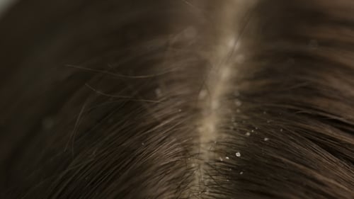 Macro Shot of Hair and Dandruff