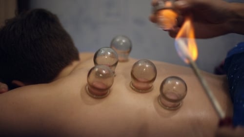 Man Receiving Cupping Therapy with Flame Preparation