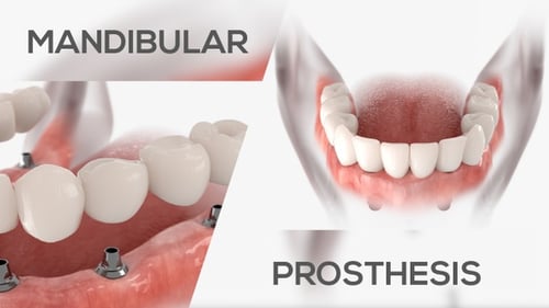 3D Medical Animation of Dental Implant Procedure and Teeth Installation