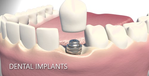 3D Animation of Dental Implant Procedure for Medical Education