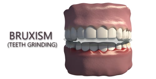 Medical 3D Animation of Teeth and Clear Aligner Application