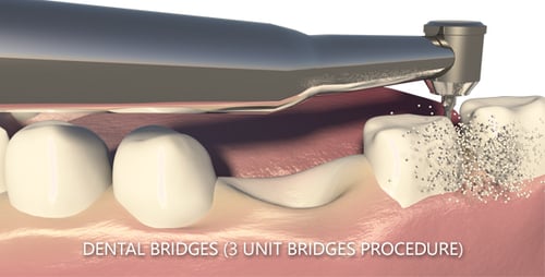 3D Dental Implants and Tooth Alignment Medical Animation