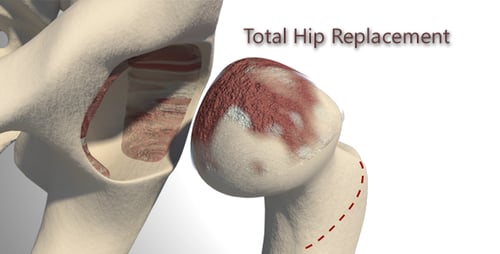3D Medical Animation of Total Hip Replacement Surgery