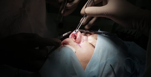 Rhinoplasty