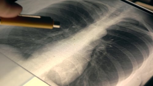 Doctor Explaining X-ray Image of a Chest